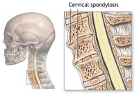 cervical_spondylosis