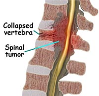 collapsed-vertebra