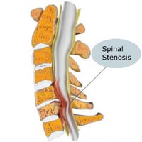 spinalstenosis.png