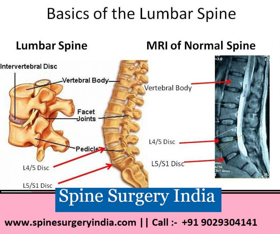 lumbar spine surgery in india
