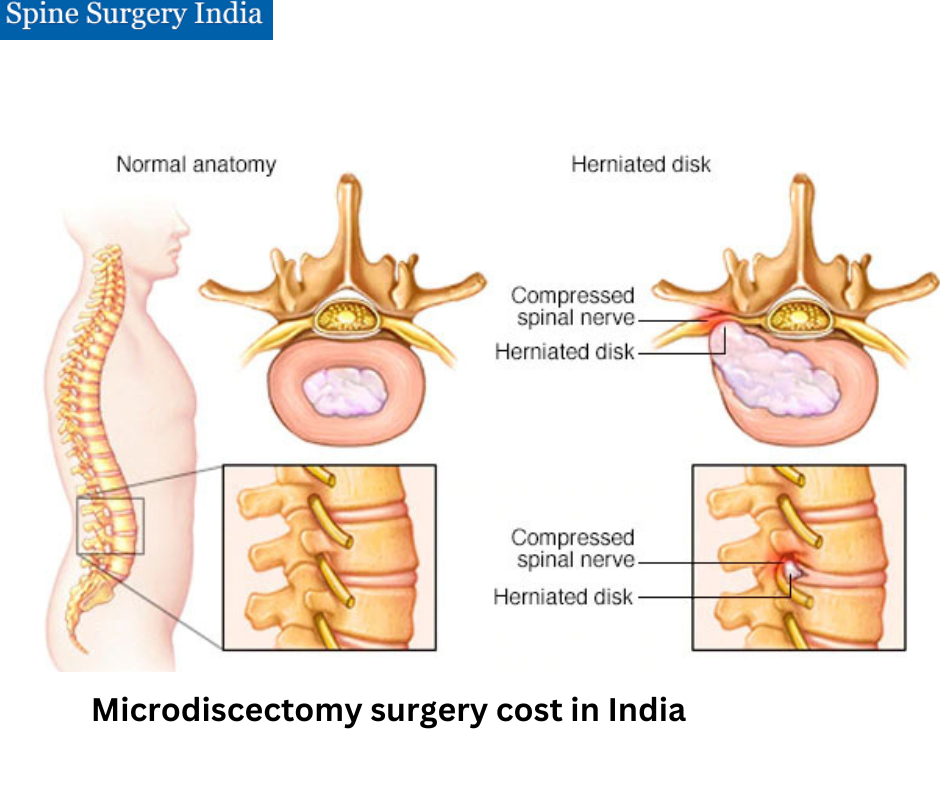 Microdiscectomy surgery cost in India