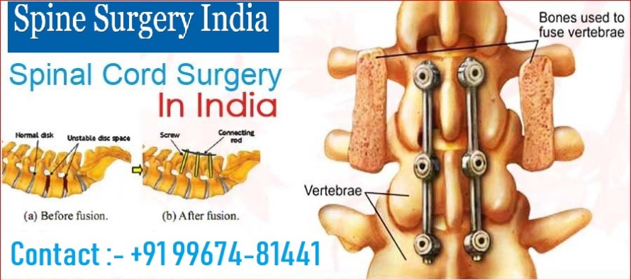 Spinal Cord Surgery in India
