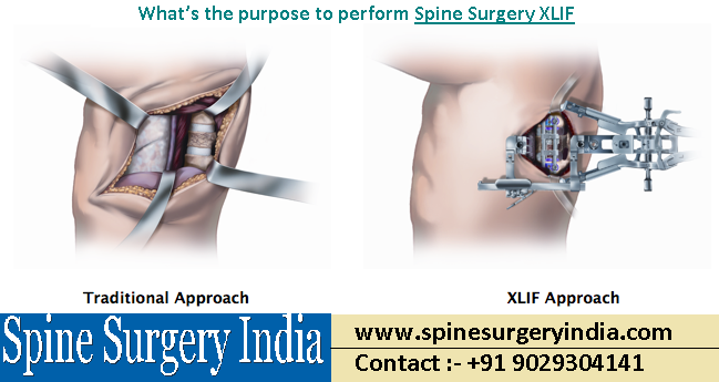 Spine Surgery XLIF