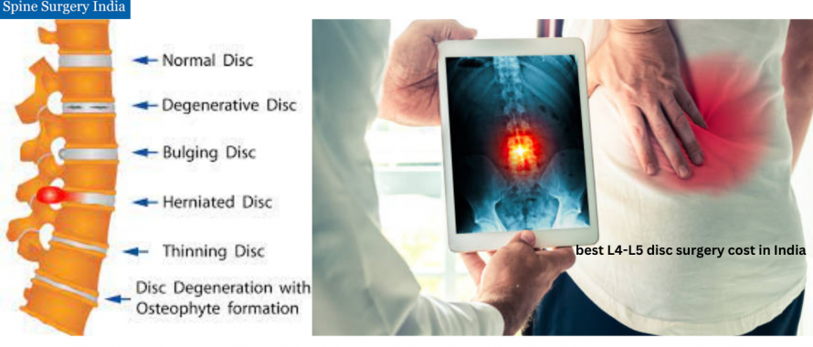best L4-L5 disc surgery cost in India